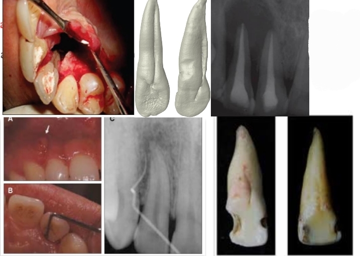 <p>Creates large permanent and irreparable periodontal bag - extraction needed</p><p class="has-focus">Is a developmental groove mainly found in <strong>maxillary lateral incisor</strong> lingual surface</p>