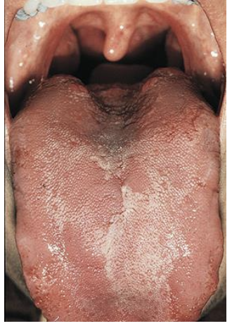 <p><strong><span>___________ </span></strong>appears as red (parakeratinized) and then paler pink to white patches (orthokeratinized) on the body of the tongue. These patches change shape with time, resembling a geographic map. These patches correspond to groups of _________ undergoing changes from epithelium, </p>