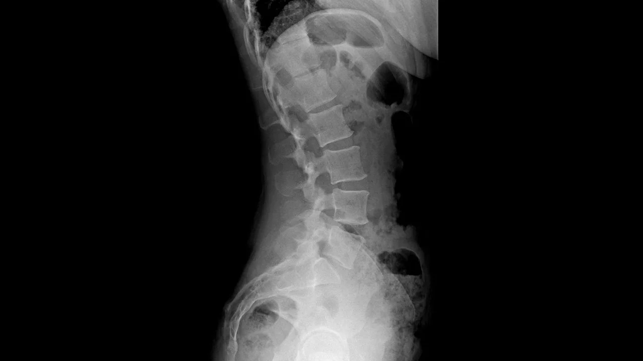 <p>Excessive inward curvature of the lower back, often causing a “swayed appearance”</p>