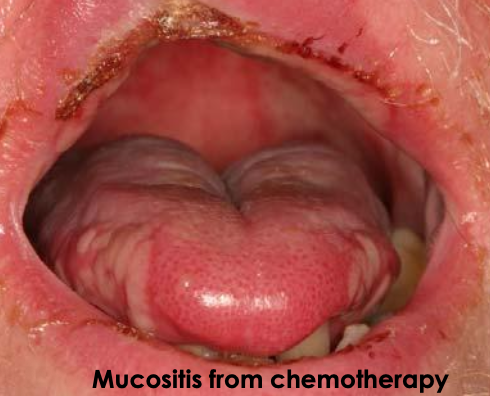 <p>What are the clinical features of <strong>chemotherapy</strong> treatment (antineoplastic)?</p>
