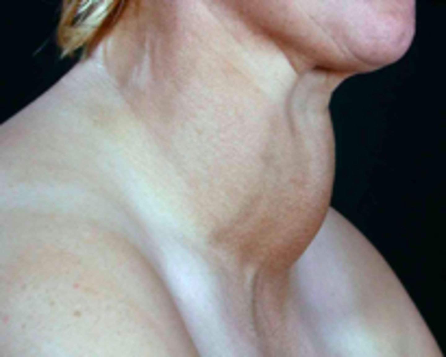 <p>patient presents with abnormal enlargement of the neck. Patient experiences feeling of tightness in the throat area and hoarseness. Blood screening shows a normal calcium levels and low iodine levels. What is the diagnosis?</p>