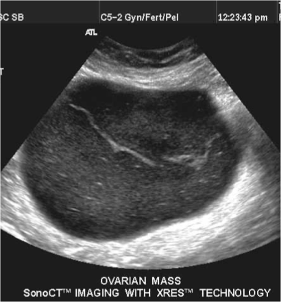 <p>whats the score of this ovarian mass?</p>