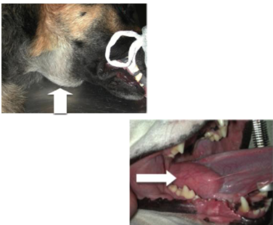 <p>A sublingual mucocele caused by rupture of sublingual salivary duct that causes accumulation of saliva and mucus at the base of the frenulum </p>