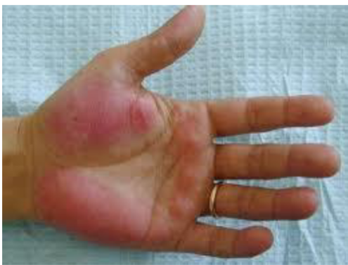 <p>What’s this called &amp; what’s it a sign of</p>