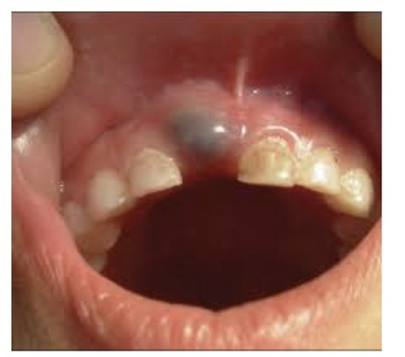 <p>Similar to a dentigerous cyst. Found in the soft tissue around the crown of an erupting tooth. Occurs only on primary teeth, fairly common. Pain associated with inflammation only, very small risk of infection. No tx.</p>