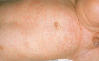<p>viral</p><p>rash appears as fever resolves</p><p>discrete macules and papules</p>
