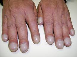 <p>lack of perfusion to extremities due to cardiovascular concern</p>