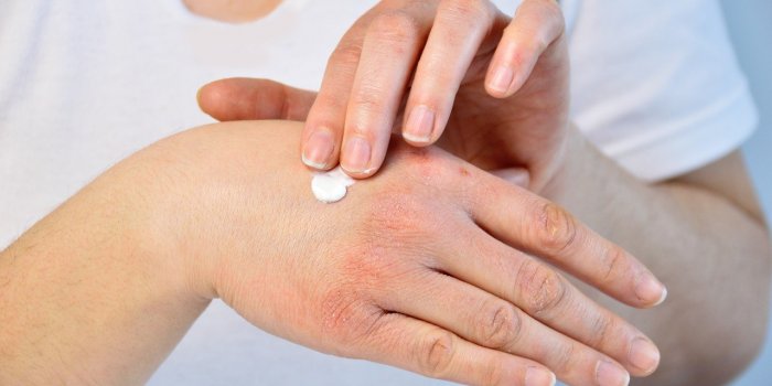 <p>qui a des __ (Petite fissure de l'épiderme dû au froid)</p>