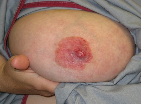 <p><span>What type of breast cancer involves the nipple &amp; skin around it? </span></p><ul><li><p><span>causes pain, burning sensation, tingling itching, scaling, crusty or hardened skin, lump in the breast and flattening of the nipple and nipple discharge</span></p></li></ul>