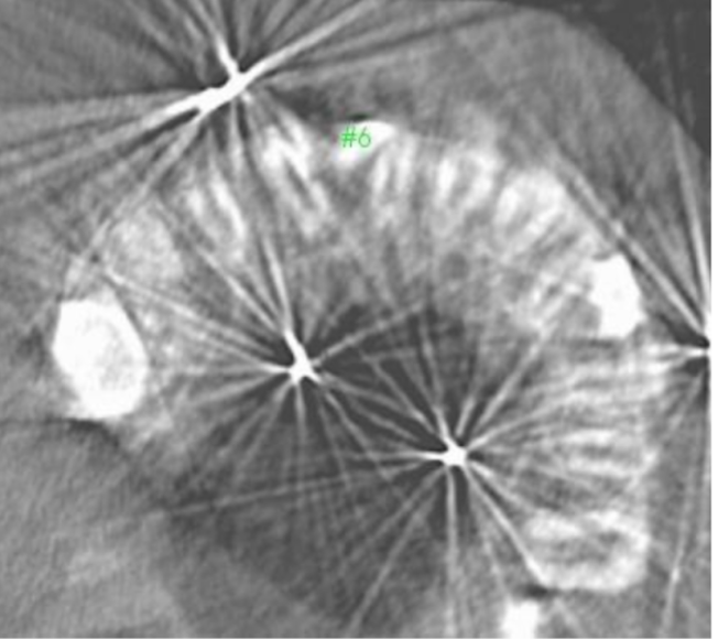 <p>what is the cause of this artifact </p>