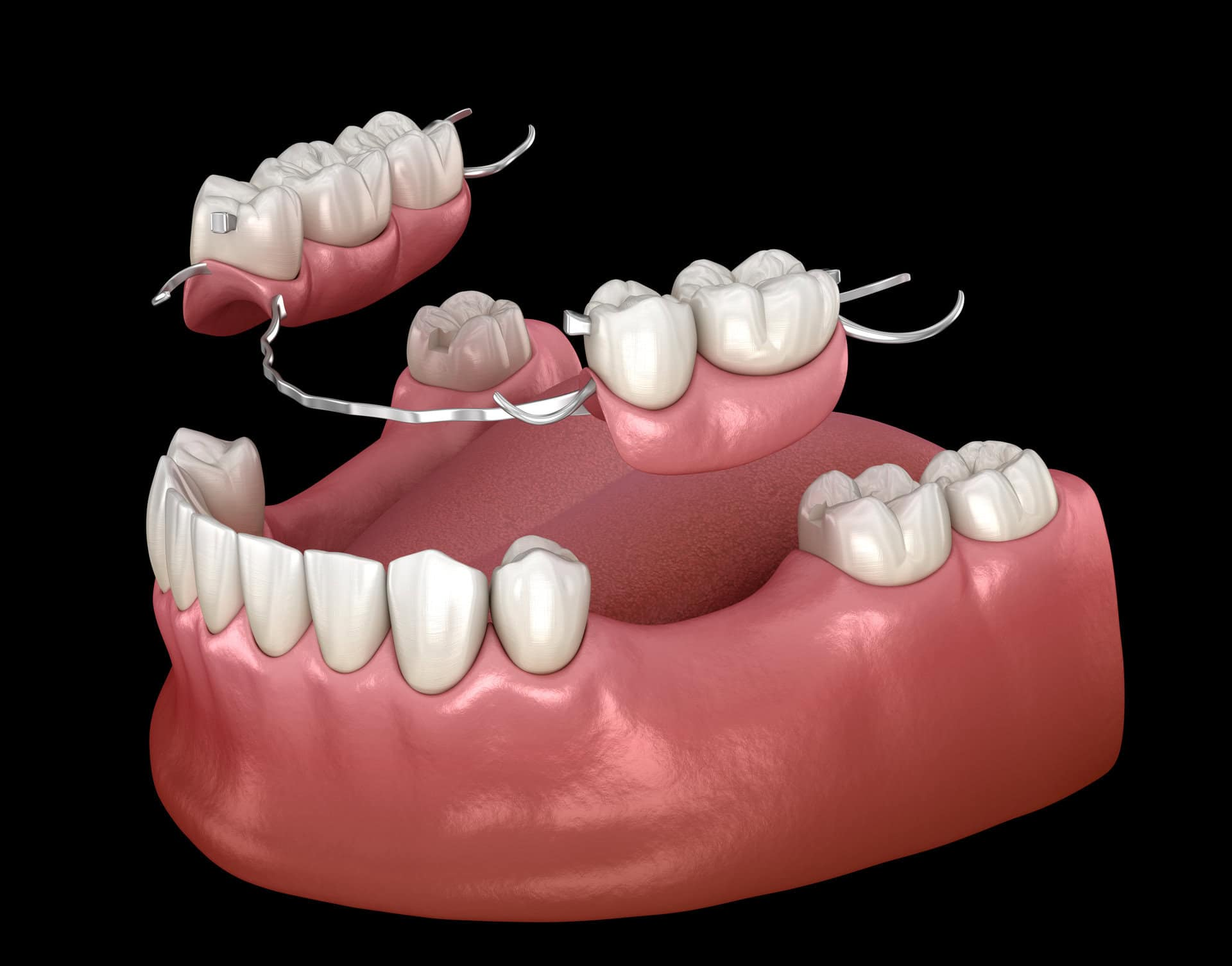 <p>Removable appliances that replace missing teeth and surrounding tissues.</p>