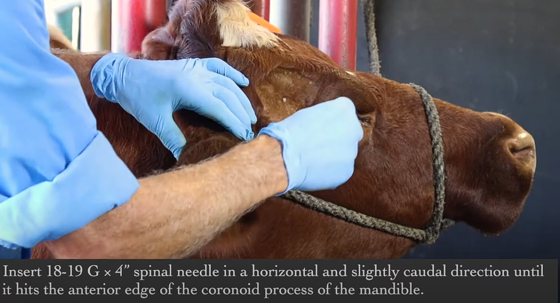 <p>Angle spinal needle parallel to ground (also perpendicular to skin) and slightly angled back - go through the bleb that you just made</p>
