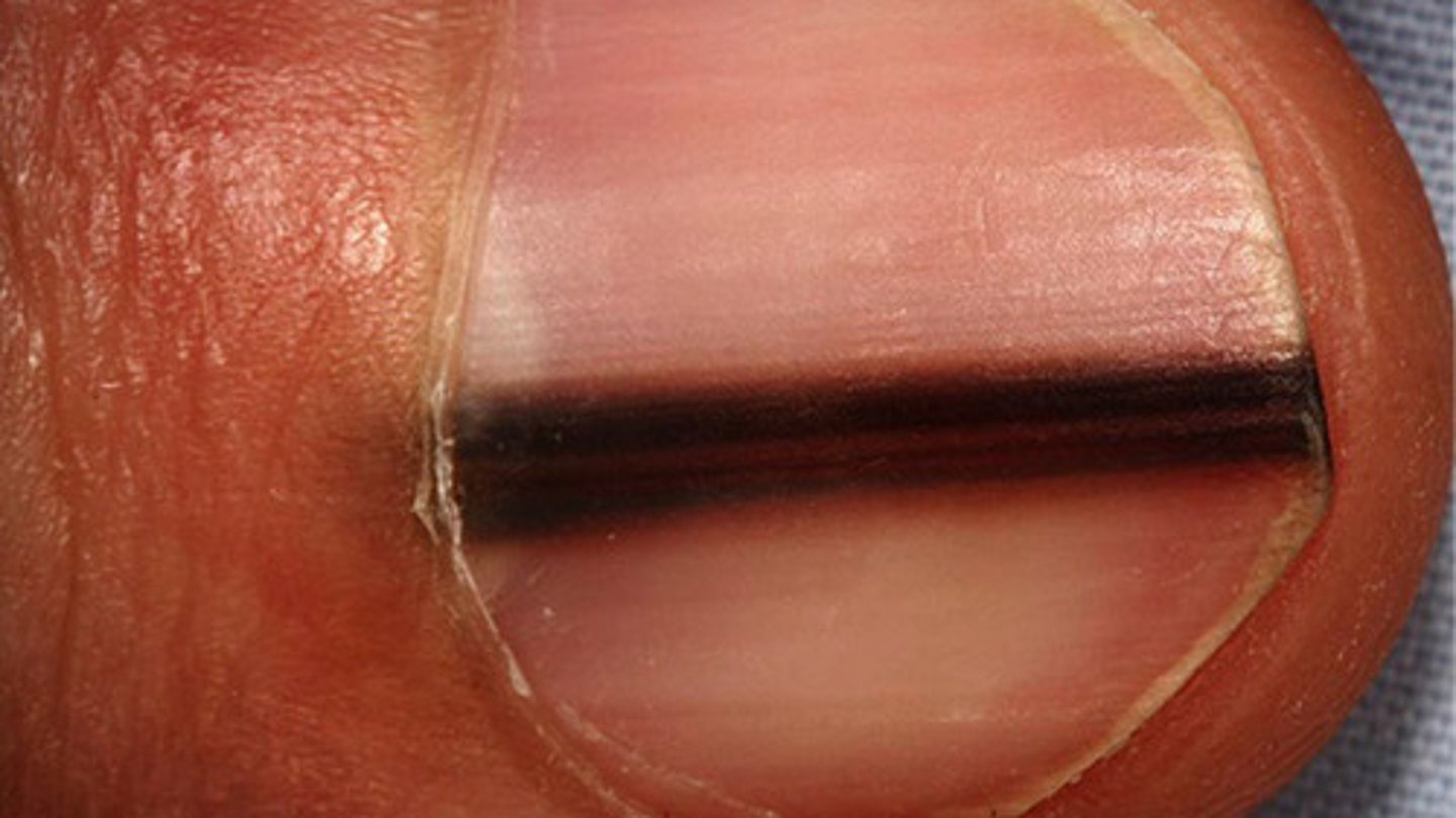 <p><mark data-color="#e0e11b" style="background-color: #e0e11b; color: inherit">Hutchinson's sign</mark> = melanonychia with a necessary extension into the perionychium</p>