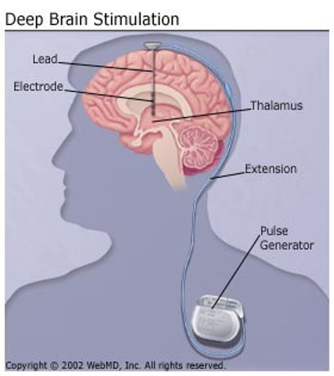 <p>◼ Surgical implanting of electrodes that administer electrical pulses to stimulate the brain</p>