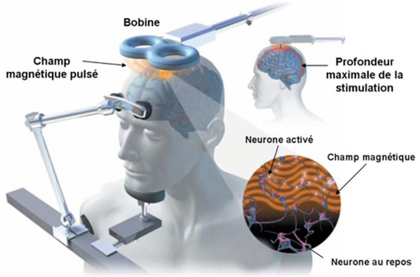 <p>- Utilise un champ magnétique pour moduler l'activité cérébrale</p><p>- Les impulsions magnétiques induisent des courants électriques qui stimulent ou inhibent l'activité neuronale</p>