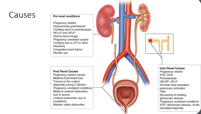<ul><li><p>Instead of just fighting the infection locally, the immune system <strong>overreacts</strong> and causes widespread inflammation.</p></li><li><p class="">One key effect of this response is <strong>massive blood vessel dilation</strong> (vasodilation). Imagine all the blood vessels suddenly expanding like a balloon. This happens because the body is trying to rush blood to fight the infection.</p></li><li><p class=""><strong>Blood pressure drops drastically</strong> → The heart can’t push blood effectively.</p></li><li><p class=""><strong>The kidneys don’t get enough blood flow</strong> → Since they depend on a steady supply of blood to function, this leads to <strong>pre-renal AKI</strong>.</p></li></ul><p></p>