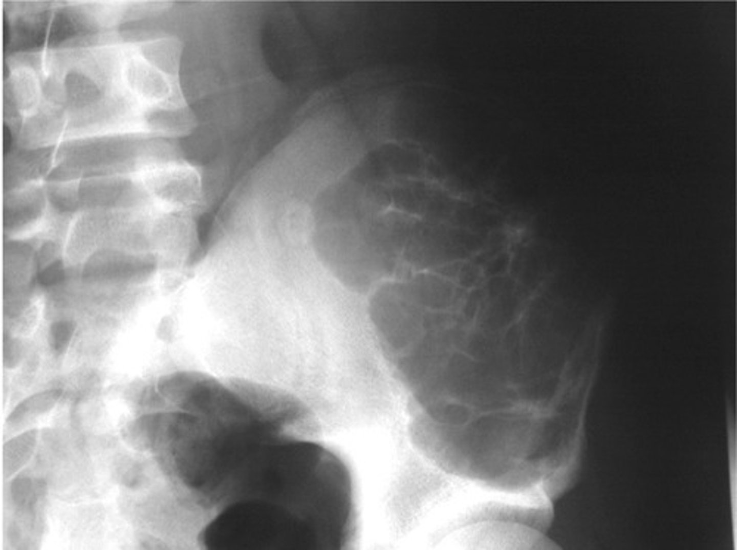 <p>Malignant tumors</p><p>Child – <strong>_______________</strong></p><p>- Metastases are also common</p>