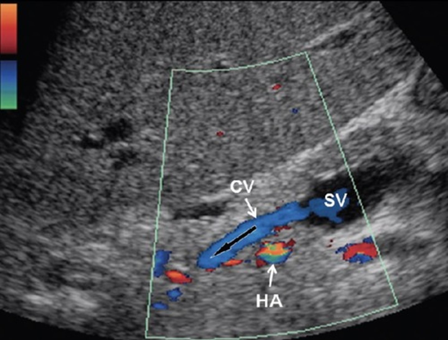 <p>Can lead to esophageal varices</p>