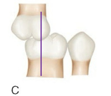 <p>angle class ___ molar relationship</p>
