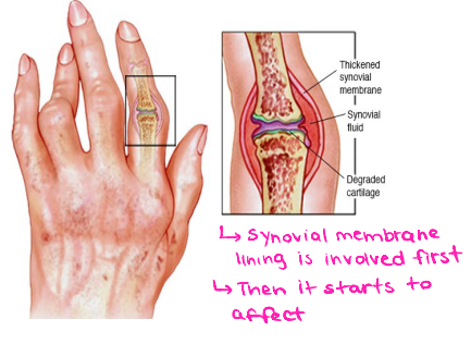 <p><strong>Rheumatoid Arthritis: Background</strong></p><p>-Chronic, systemic disease characterized by inflammatory ____________, involving small and large joints, some other organ systems, and some constitutional features </p><p>-Epidemiology</p><ul><li><p>Females _ males</p></li><li><p>Onset between 30-50 y/o</p></li></ul><p>-Pathogenesis</p><ul><li><p>Type __ reaction (T cell mediated)</p></li></ul><p>-Genetics</p><ul><li><p>Most associated with HLA ___ _ and _</p></li></ul><p>-Environmental Trigger</p><ul><li><p>Mostly unknown</p></li><li><p>__________ highly linked trigger to RA</p></li></ul><p></p>