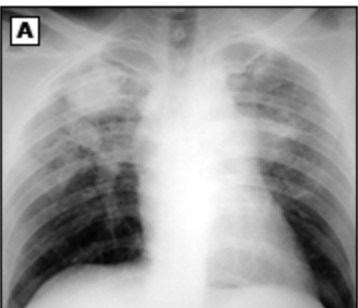 <p>What is the MAJOR characteristic of complicated CWP?</p>