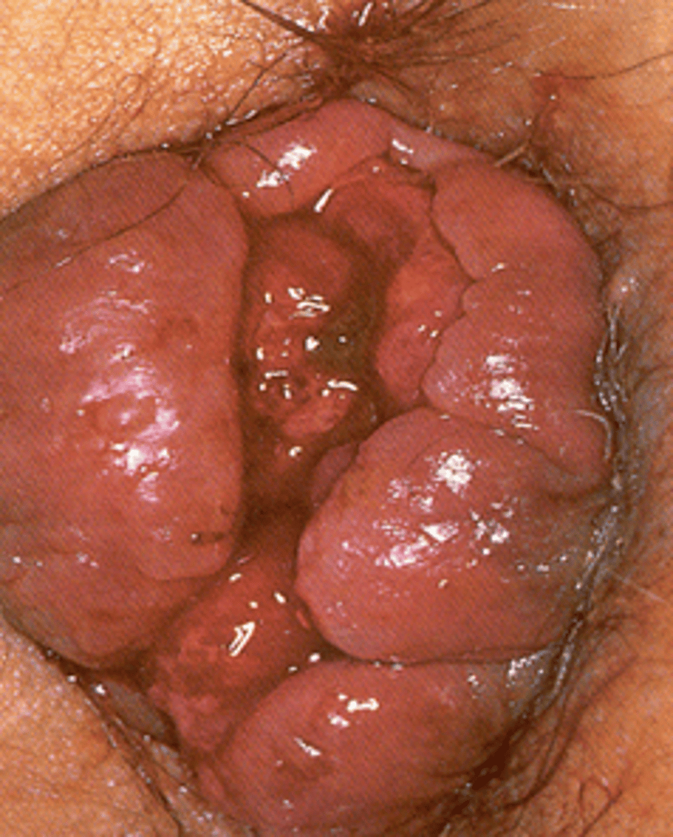 <p>A pt presents with <strong>bleeding </strong>and protrusion. Upon PE you see the image attached. If the diagnosis is clinical --- what is the likely dx?</p>