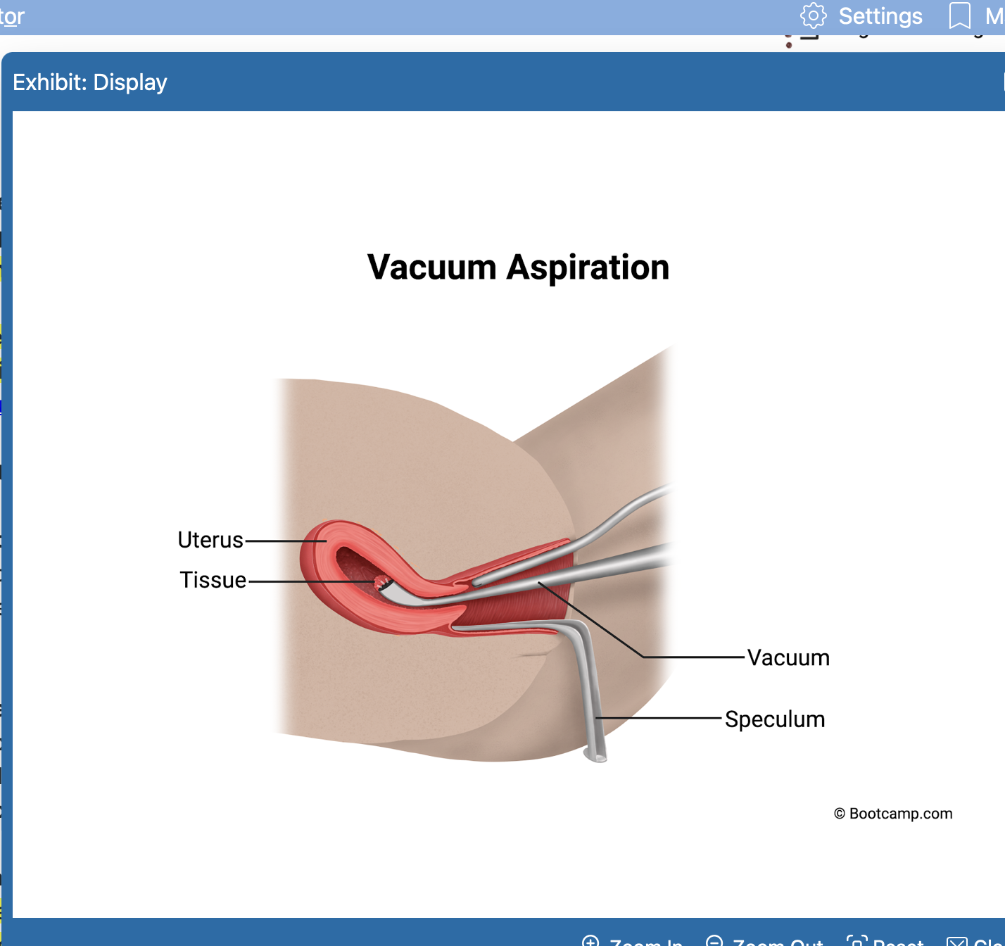 <ul><li><p>molar pregnacy</p></li><li><p>need to be removed <strong>immediately</strong> via vacuum aspiration and curettage </p></li></ul><p></p>