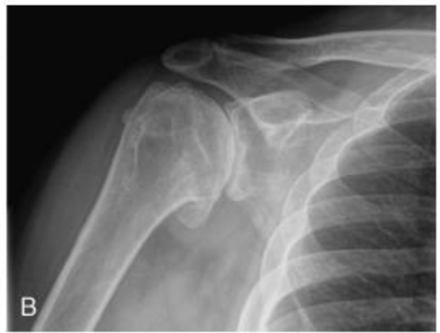 <p>What does the image show?</p><p>- Increased whitening of glenoid and humeral head (_________________)</p><p>- ________________ joint space</p><p>- Bone ___________________</p><p>- __________________ formation</p>