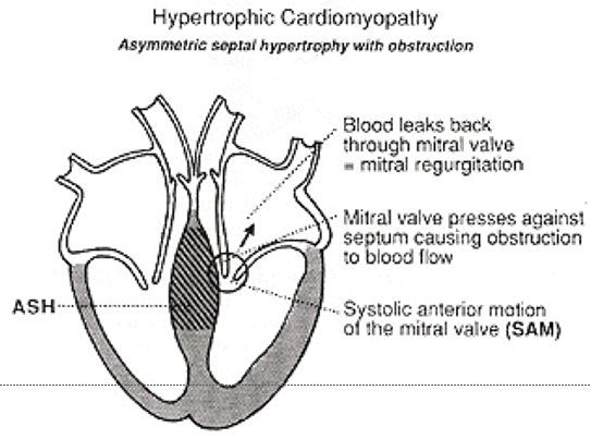 <p><span><strong>Murmur in HCM</strong></span></p><p>2 causes?</p>