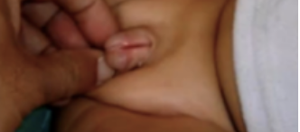 <p>Rare‬ congenital‬‭ (present‬‭ at‬ birth) ‬‭anomaly‬‭ involving‬ the‬‭ development‬‭ of ‬‭the‬ urethra;‬</p><p>Urethral‬‭ meatus‬‭ is‬ located ‬‭on ‬‭top ‬‭of‬‭ glans‬ (dorsal‬ side)‬</p>