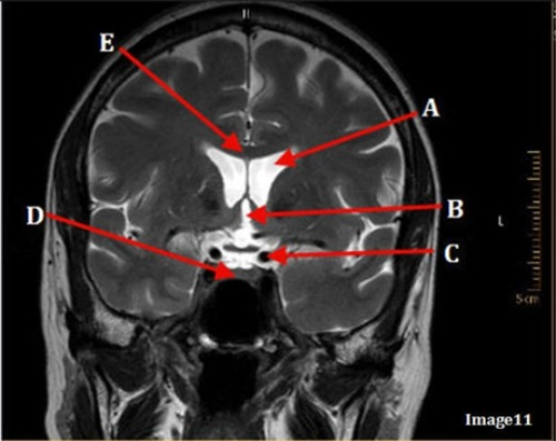 <p>Image 11 is an example of a _______ weighted sequence acquired in the _______ scan plane.</p><p>A. T1; Axial</p><p>B. T1; Coronal</p><p>C. T2; Axial</p><p>D. T2; Coronal</p><p>E. STIR; Axial</p>