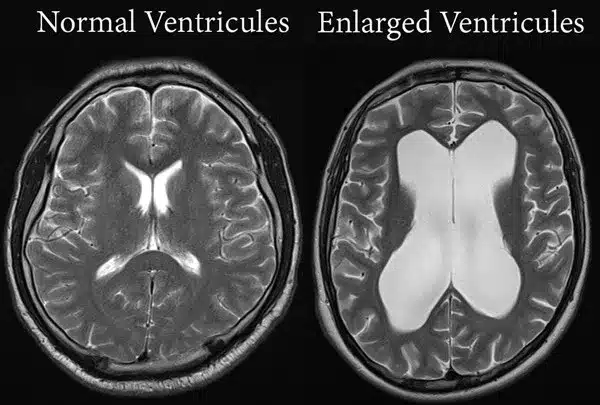 <p>buildup of CSF in the ventricles, compresses rest of brain and causes memory loss, etc.</p>