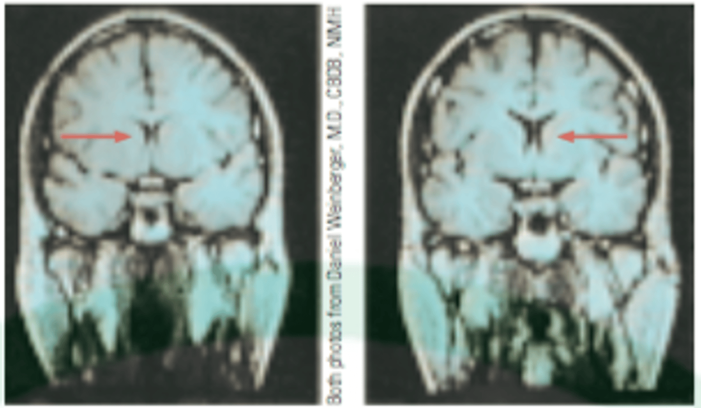 <p>neuro imaging evidence has revealed structural differences in the brains between SZ and non SZ.</p><p>SZ have larger ventricles, fluid filled cavities. means sz brains are typically lighter than normal. 20-25% of sz have larger ventricles</p>