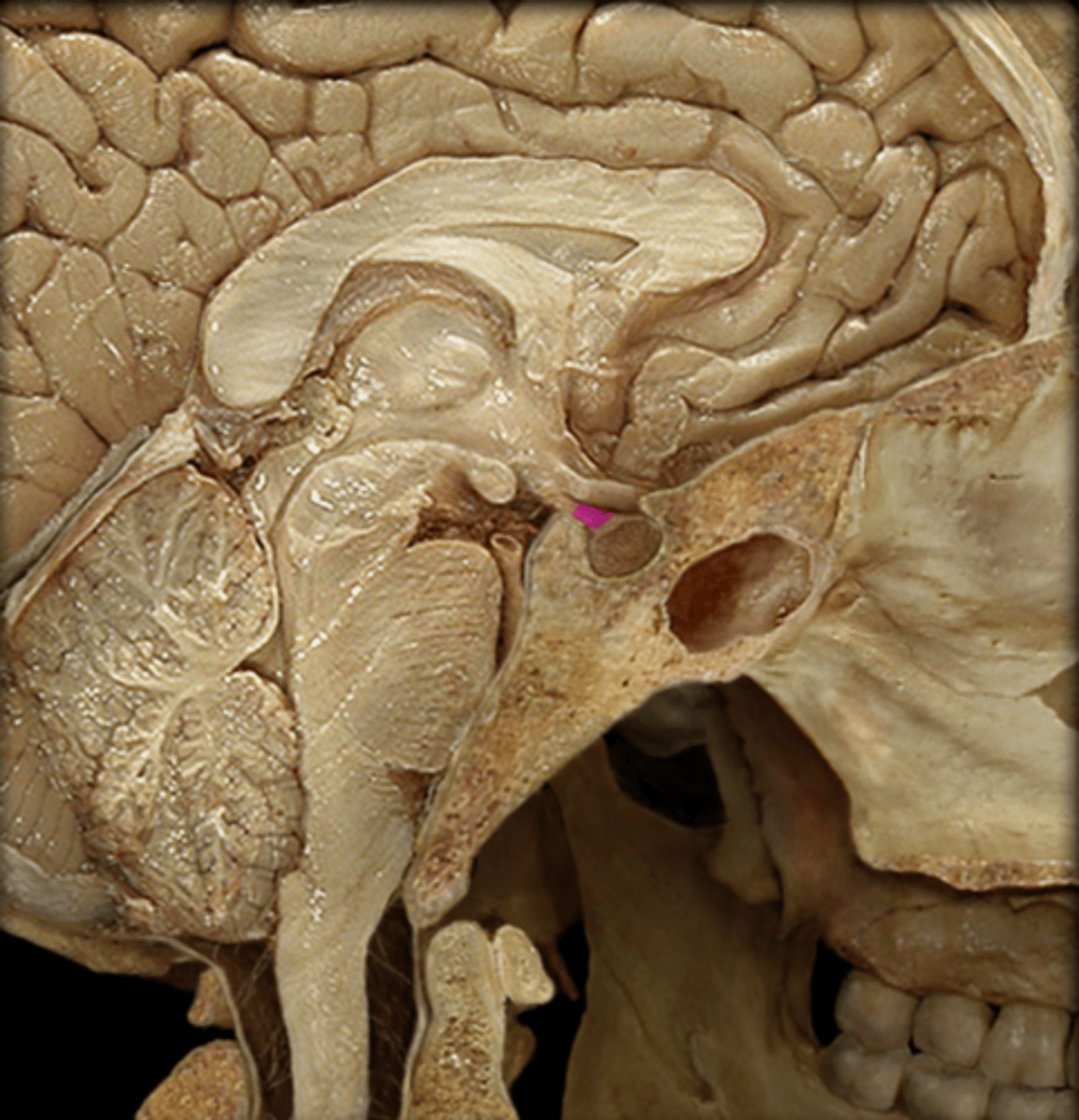 <p>This region connects the hypothalamus and the pituitary gland.</p>