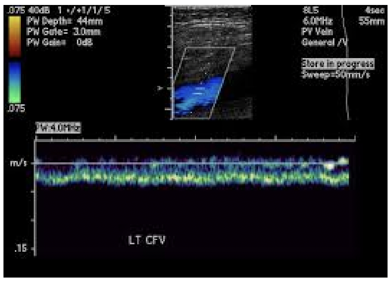 <p>Based on this, is this a normal venous blood flow?</p>
