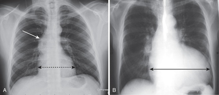 <p>Cardiac Remodeling</p>