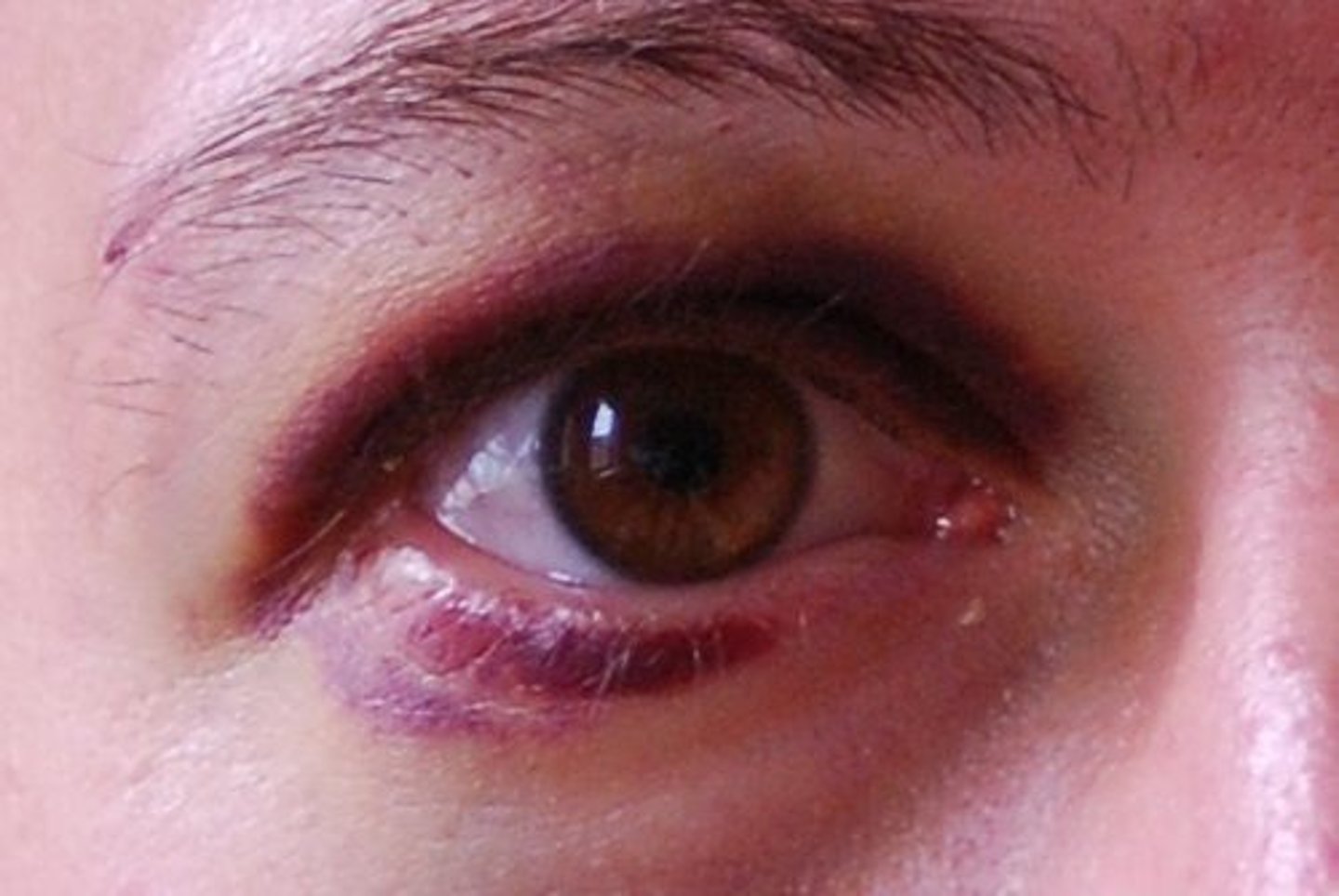 <p>simplest closed wound, also known as a bruise. They are caused when the body is subjected to a force</p>