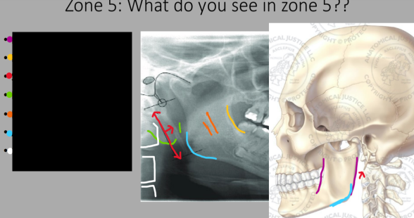 <p>What do we see in Zone 5?</p>
