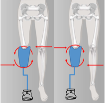 Foot Inset => pressure lat/distal + med/proximal
Foot outset => pressure med/distal + lat/proximal