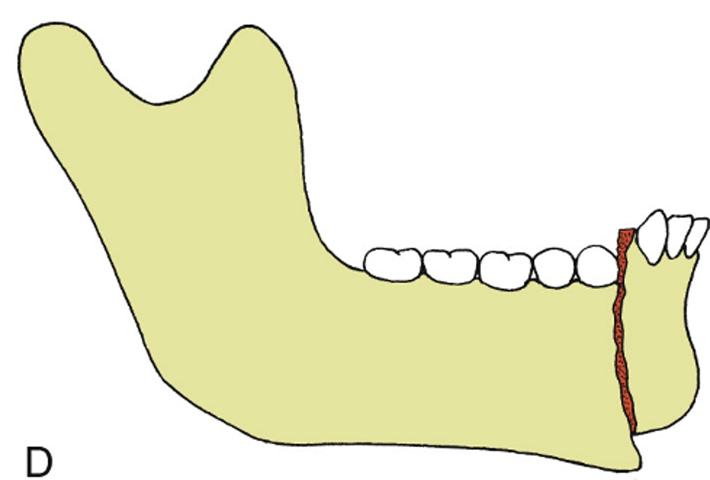 <p>ID the type of mandibular fracture:</p><p>•a fracture that communicates with the oral or external environment</p><p>•A fracture that is open into the mouth (via the periodontal ligament/gingival sulcus or a visible step</p><p>•A fracture open to the sinus or the skin</p>