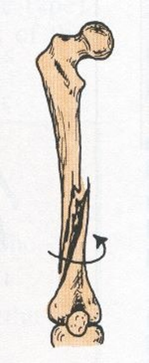 <p>caused by excessive twisting of a bone</p>