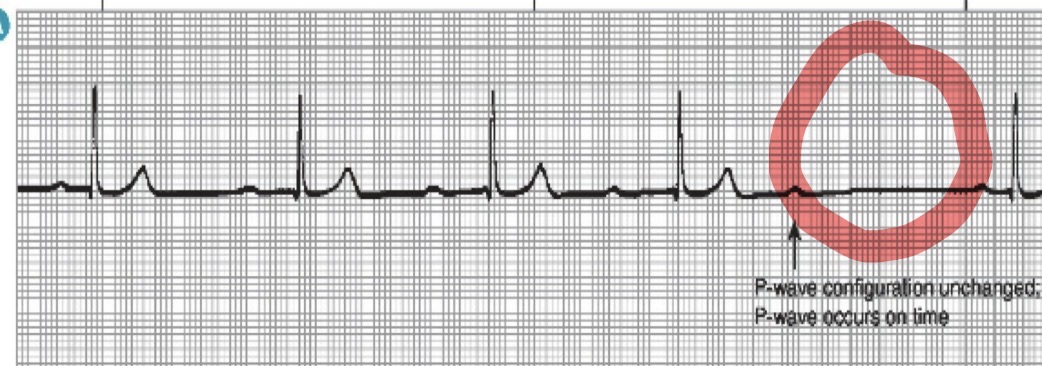 <p>Second degree heart block Mobitz Type I (Wenckebach)</p>