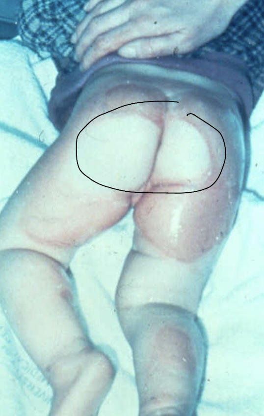 <p>donut sparing shape and sparing behind knees</p>