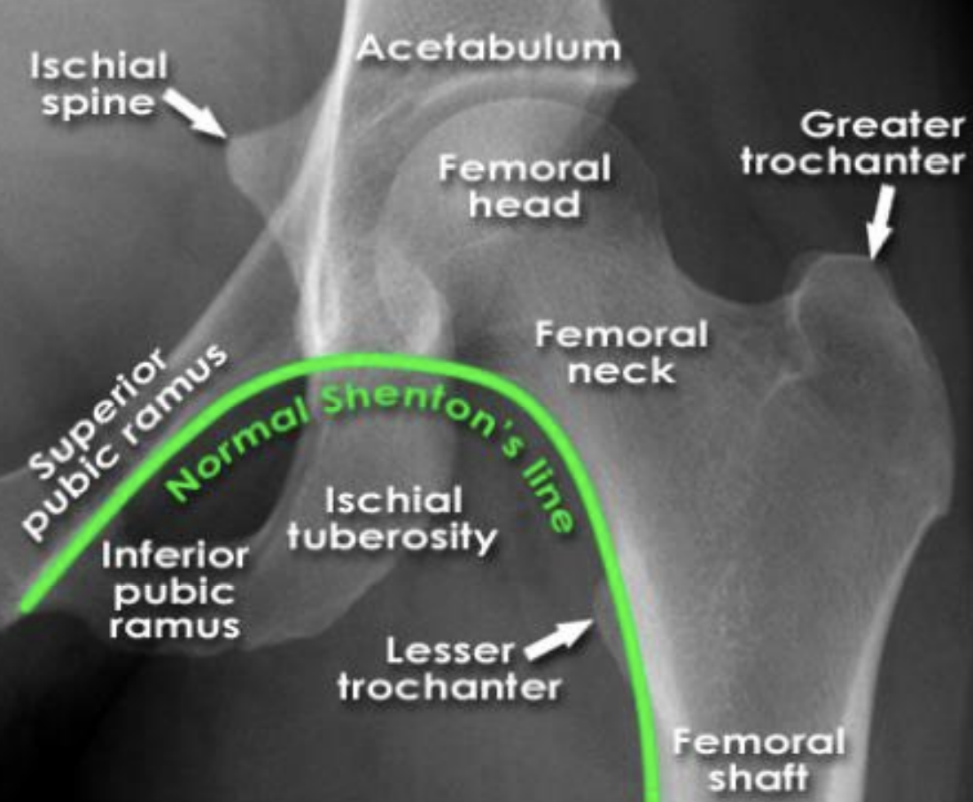 <ul><li><p>lined formed by anatomical landmarks in a normal AP scan of a hip</p></li></ul><p></p>