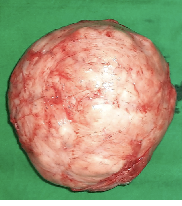 <p><span><span>Describe the gross appearance.</span></span></p><p style="text-align: left;"><span><span>What is the cell of origin?</span></span></p><p style="text-align: left;"><span><span>What is the diagnosis?</span></span></p><p style="text-align: left;"><span><span>What is the malignant counterpart called?</span></span></p>