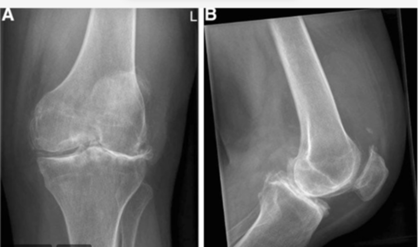 <p>Work through your "ABCS". Start with B: bone density.</p>