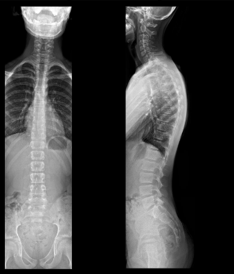 <p>Wat kunnen we kenmerkend op Radiografie herkennen?</p>