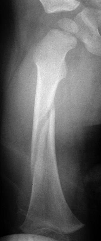 <p>What type of fracture is this? (Bonus points for full explanation)</p>