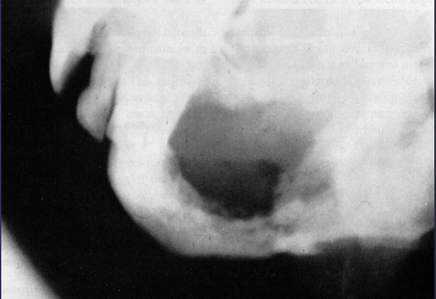 <p>What would be a differential diagnosis for this lesion?</p>