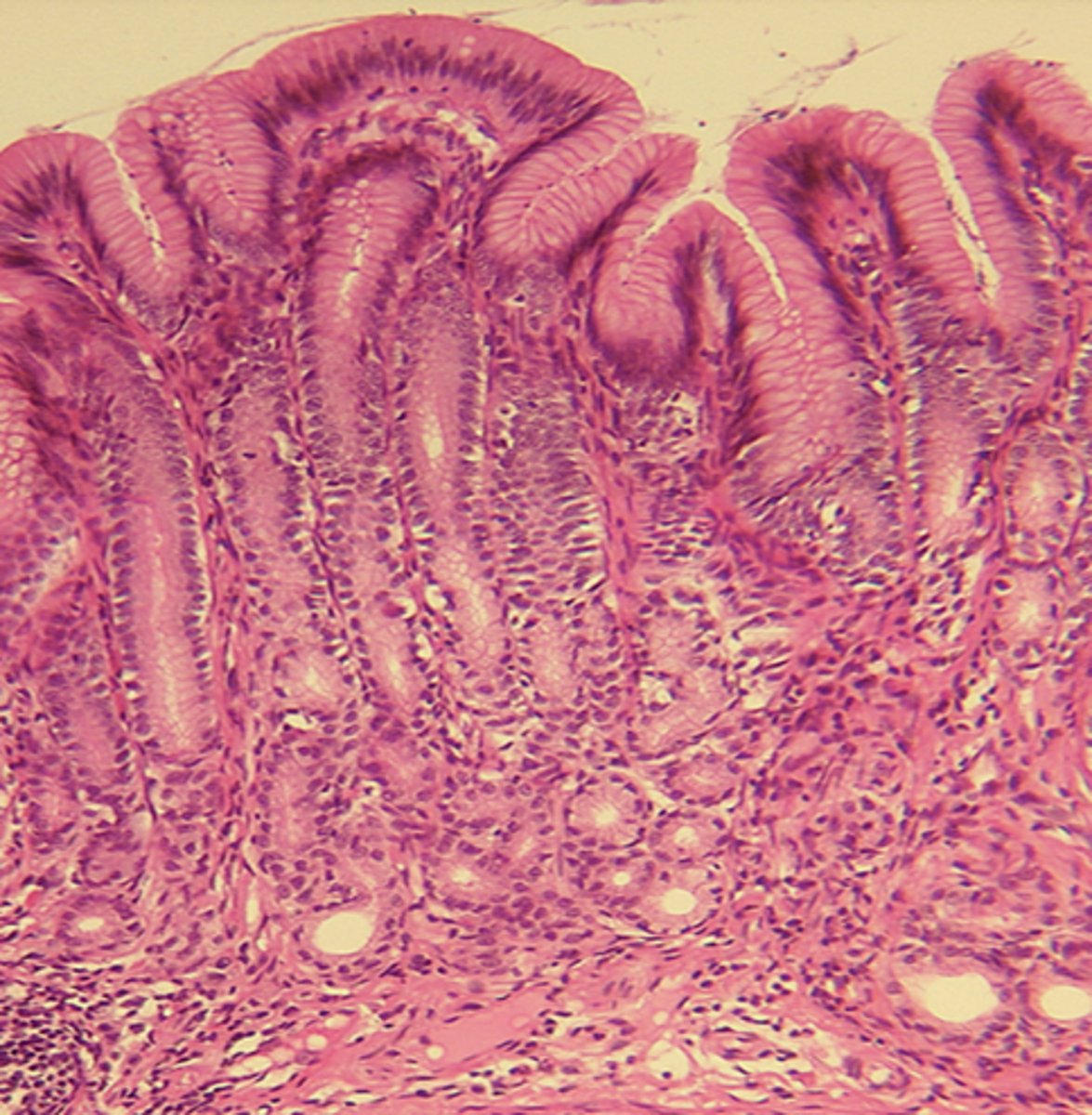 <p>deep pits and branched glands</p>
